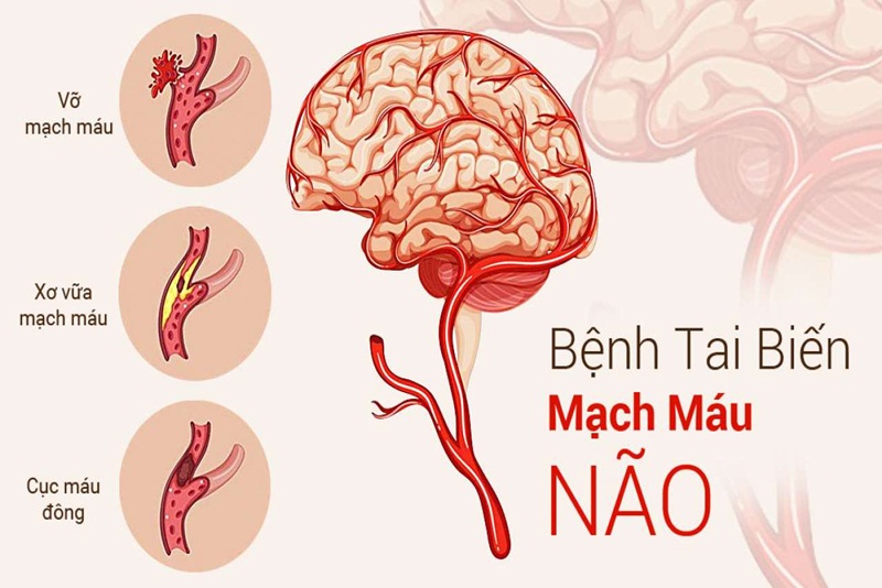 Nguyên nhân gây tai biến mạch máu não mà không phải ai cũng biết
