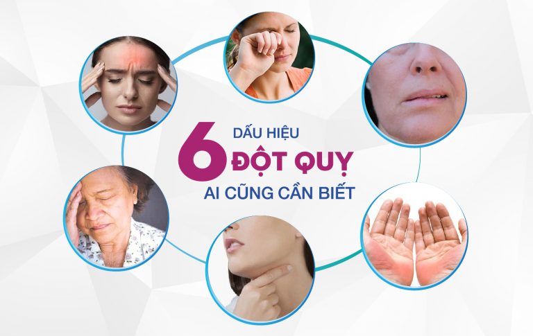 Đột quỵ: Các dạng phổ biến và cách dự phòng từ sớm