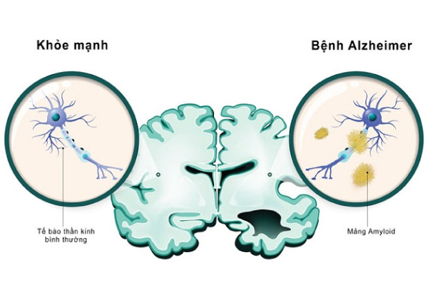 Alzheimer thường được biết đến là bệnh tuổi già