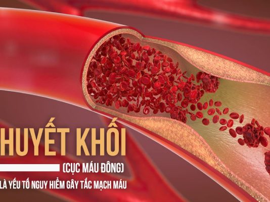 Nguyên nhân hình thành huyết khối và cách dự phòng từ sớm