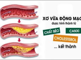 Tìm hiểu các cách chẩn đoán xơ vữa động mạch